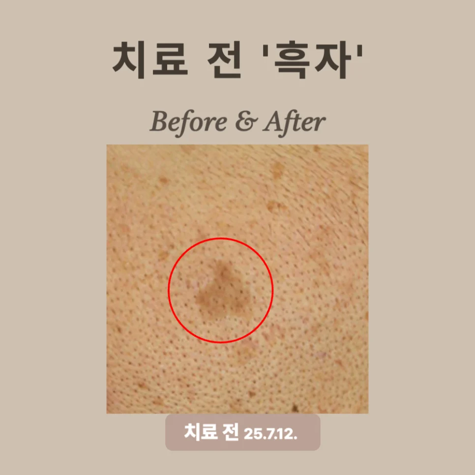 50대 리팟레이저 시술 후기: 경계 뚜렷한 흑자 제거 성공!