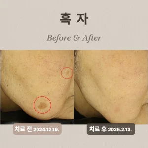 리팟레이저, 왜 흑자 제거에 효과적이라고 불릴까?