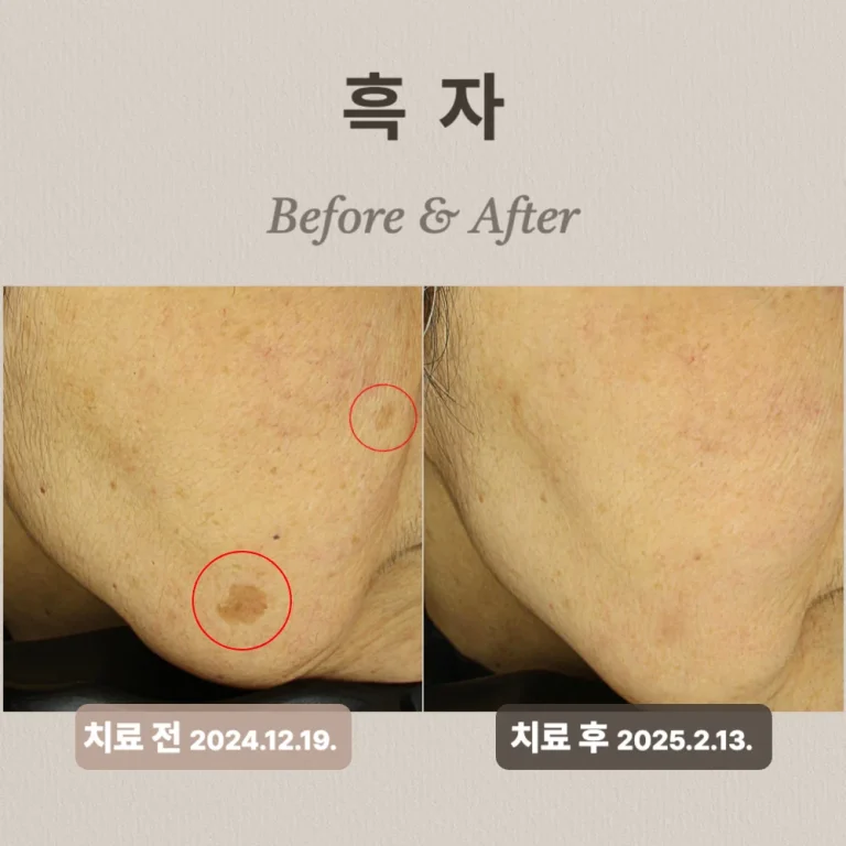 리팟레이저, 왜 흑자 제거에 효과적이라고 불릴까?