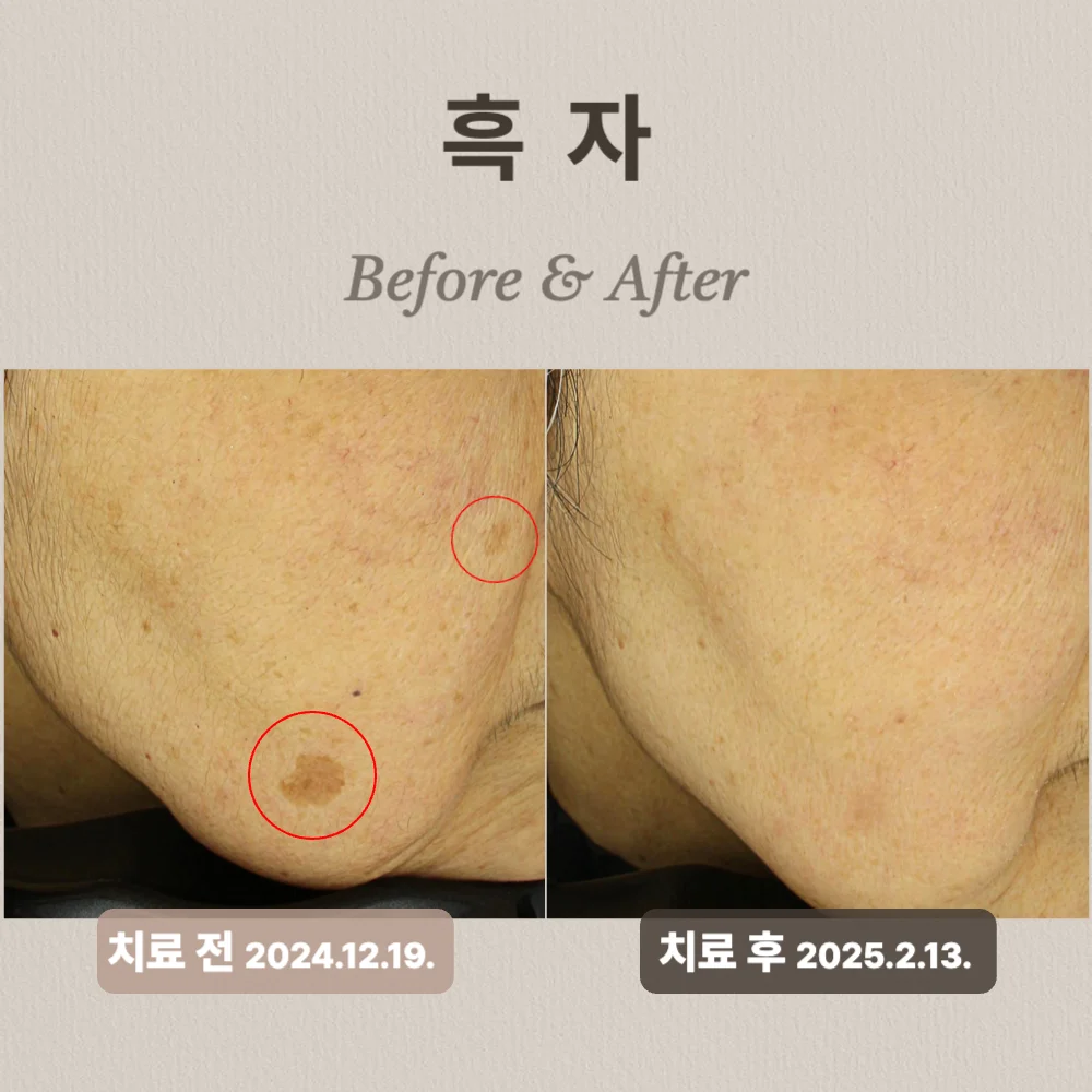 60대 여성,  흑자치료 후기