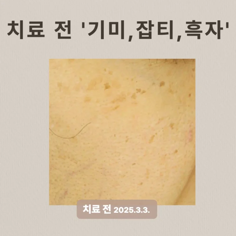 40대 여성 흑자 제거 후기 #기미, #잡티