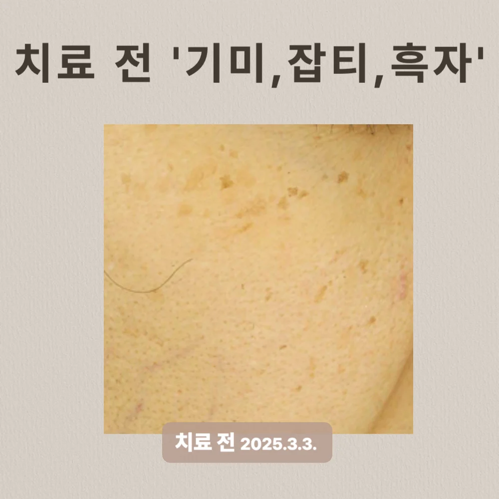 40대 여성 흑자 제거 후기 #기미, #잡티