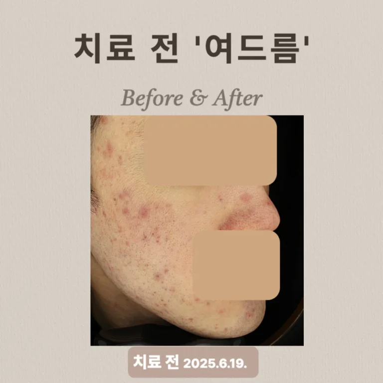 20대 여드름 압출·브이빔 치료 후기