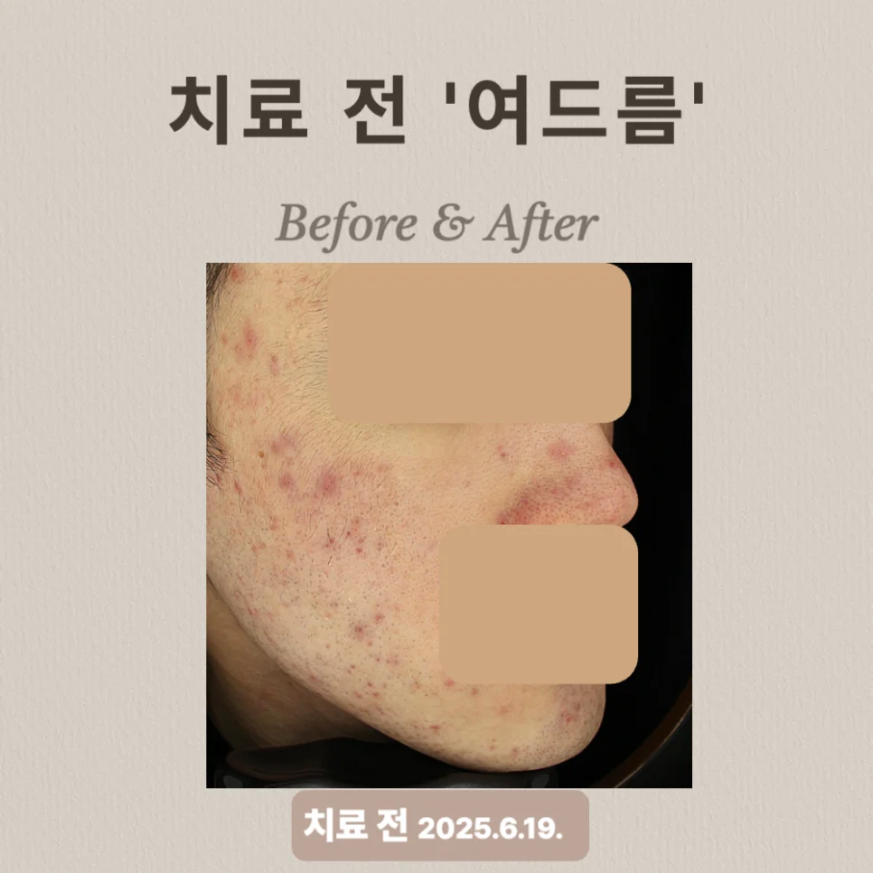 20대 여드름 압출·브이빔 치료 후기