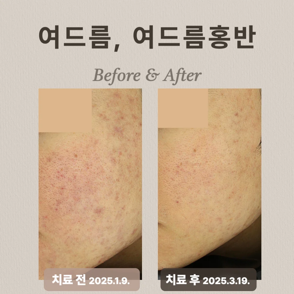 20대 남성, 여드름, 여드름홍반 치료 후기