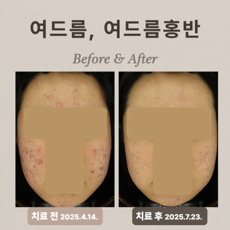 20대 홍반 치료 방법, 브이빔 시술 후기