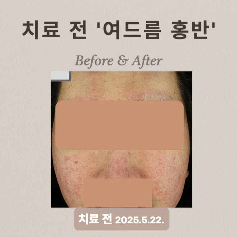 20대 여드름 압출과 브이빔 치료 후기, 횟수별 효과는?
