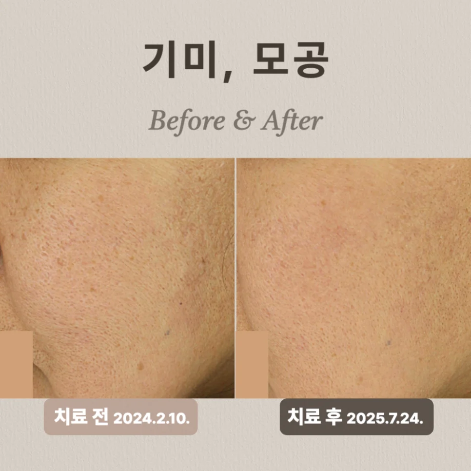 40대 도자기 프로그램 후기: 기미·모공 개선 비법!