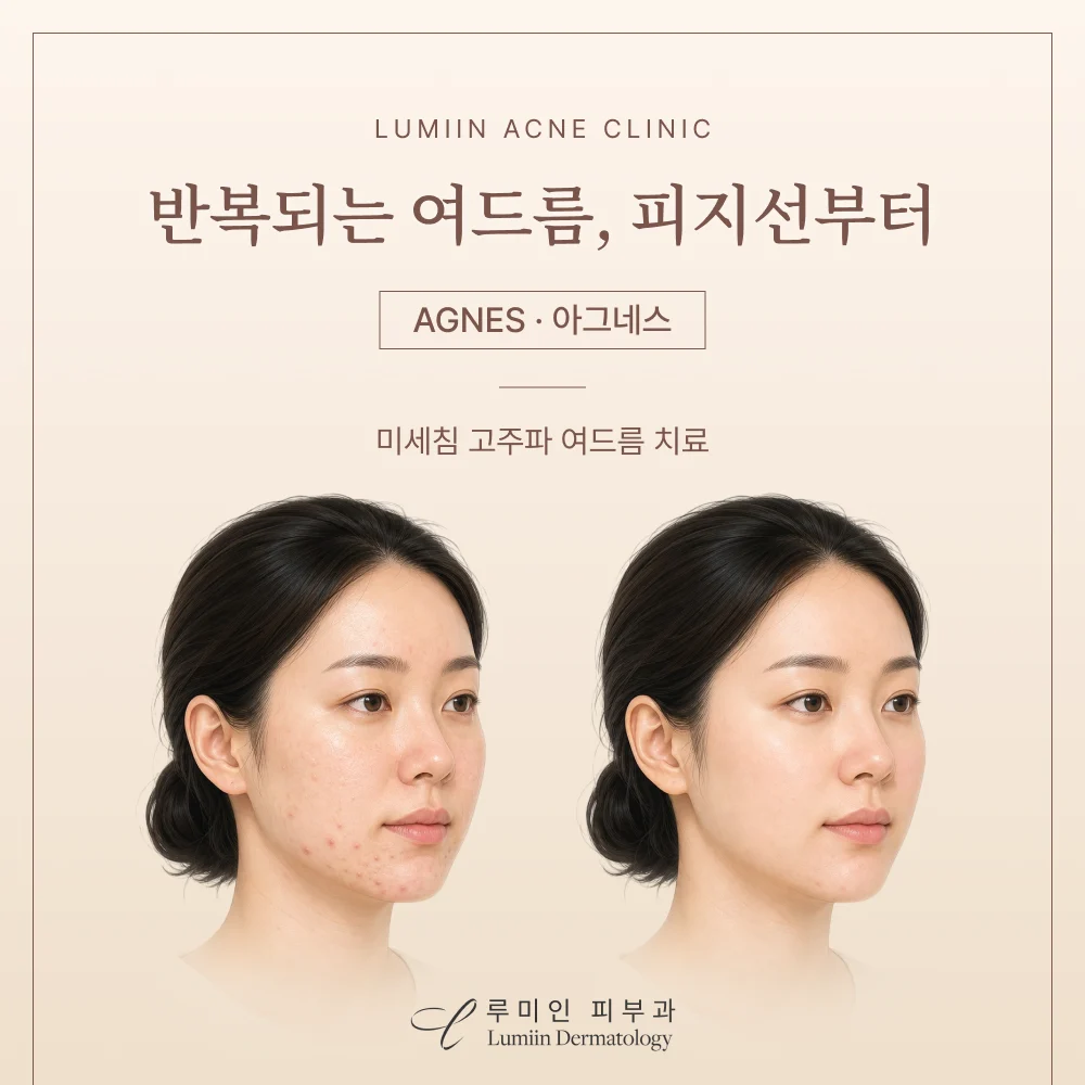 반복되는 여드름치료