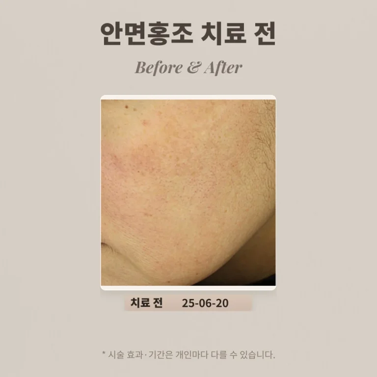 40대 여성 안면홍조, 붉은자국 치료 후기_대치동피부과전문의