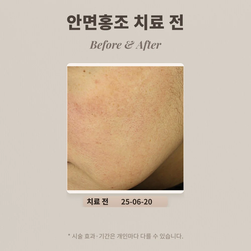 40대 여성 안면홍조, 붉은자국 치료 후기_대치동피부과전문의
