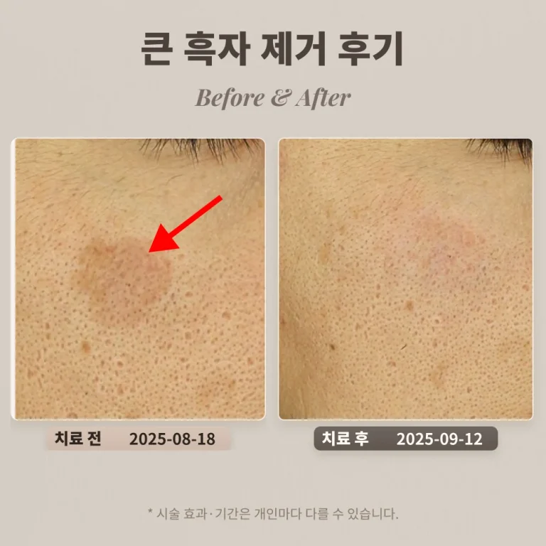 40대 남성 큰 흑자 제거 후기