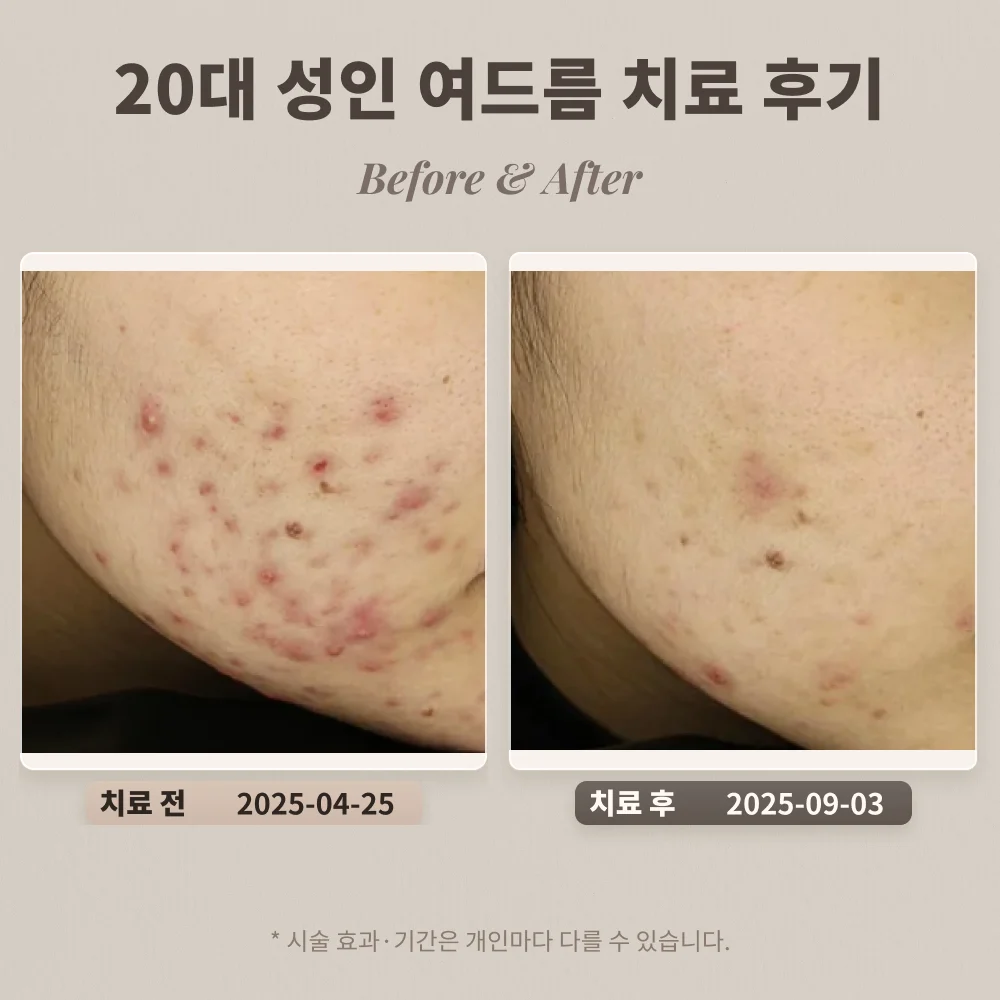 20대 여성 턱과 볼에 난 성인 여드름 치료 후기_대치동피부과