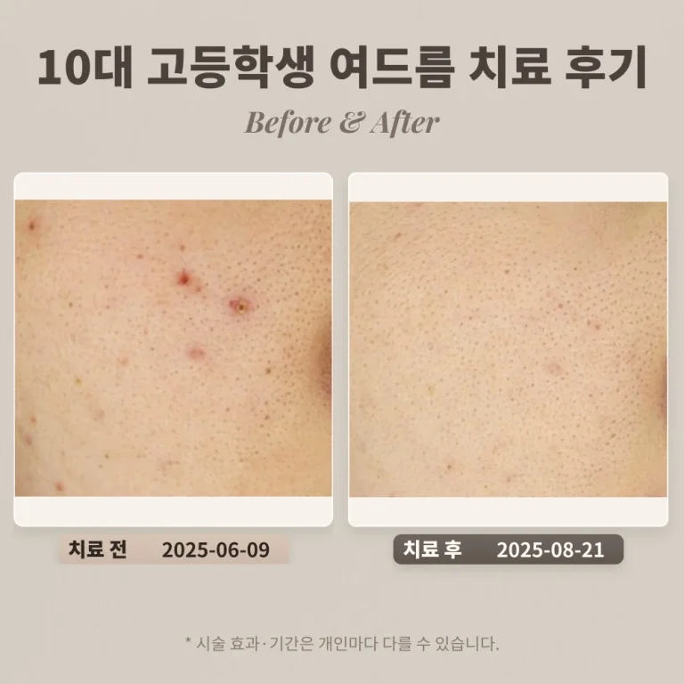 10대 고등학생 여드름 치료 후기_대치동 피부과