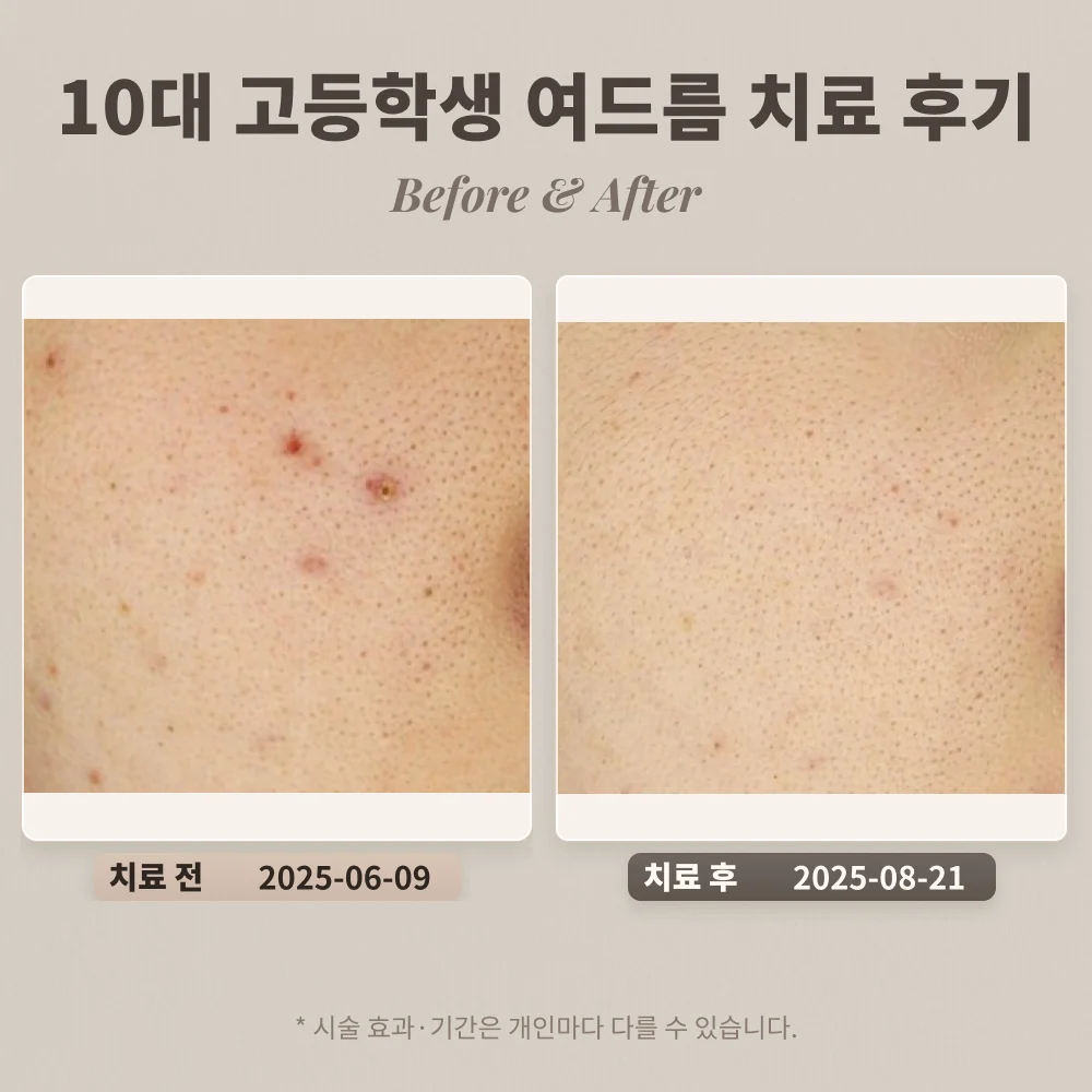 10대 고등학생 여드름 치료 후기_대치동 피부과