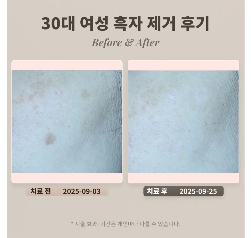 30대 여성 흑자 제거 후기 #얼굴에 난 갈색 반점