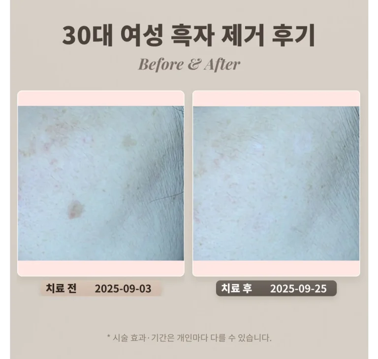 30대 여성 흑자 제거 후기 #얼굴에 난 갈색 반점