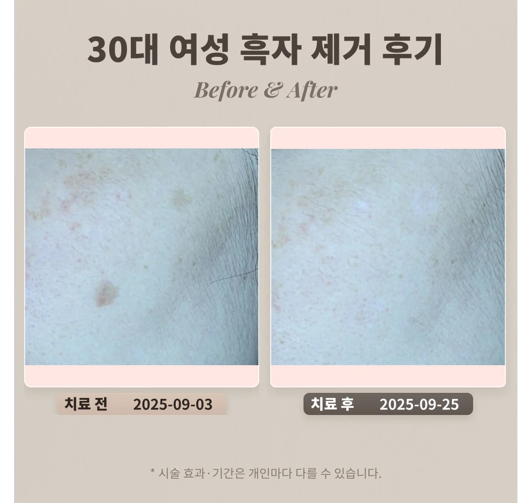 30대 여성 얼굴 갈색 반점 흑자 치료 사례