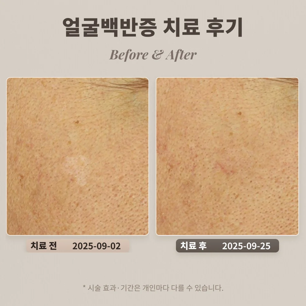 50대 남성 얼굴 백반증 치료 후기 #백반증전문피부과