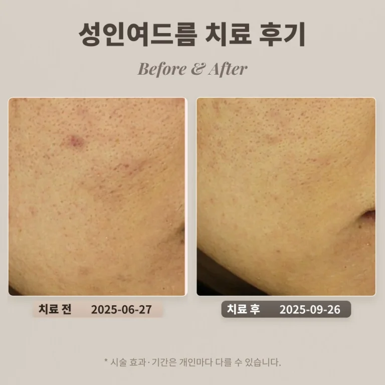 20대 성인여드름 치료 후기 #한티역피부과전문의