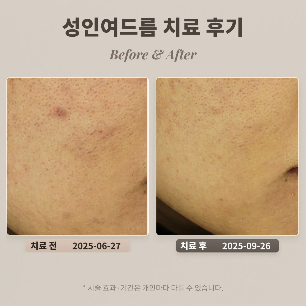 20대 성인여드름 치료 후기 #한티역피부과전문의
