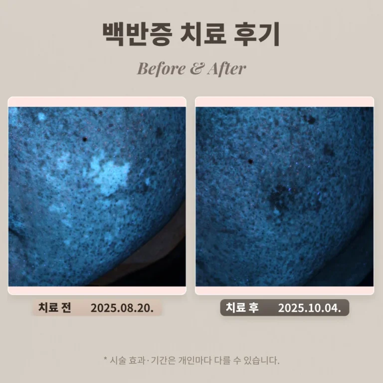 40대 백반증 남성 치료 후기 #백반증 치료기간 길까?