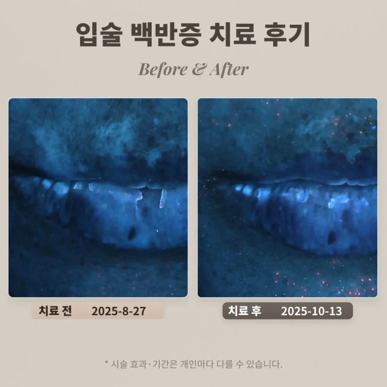 30대 입술 백반증 치료 후기 #백반증 조기 치료 방법