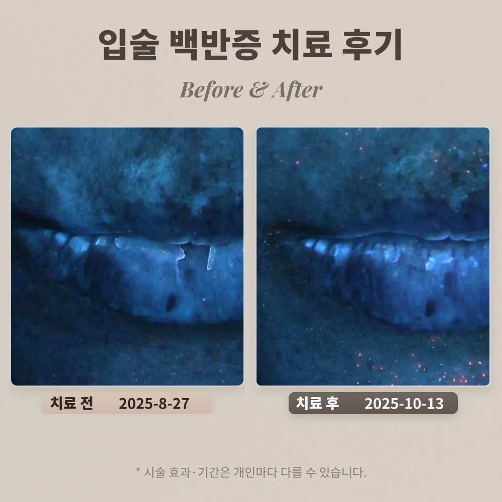 30대 입술 백반증 치료 후기 #백반증 조기 치료 방법