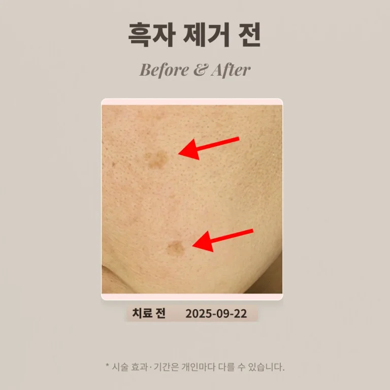 40대 일광 흑자 제거 후기 #강남피부과전문의