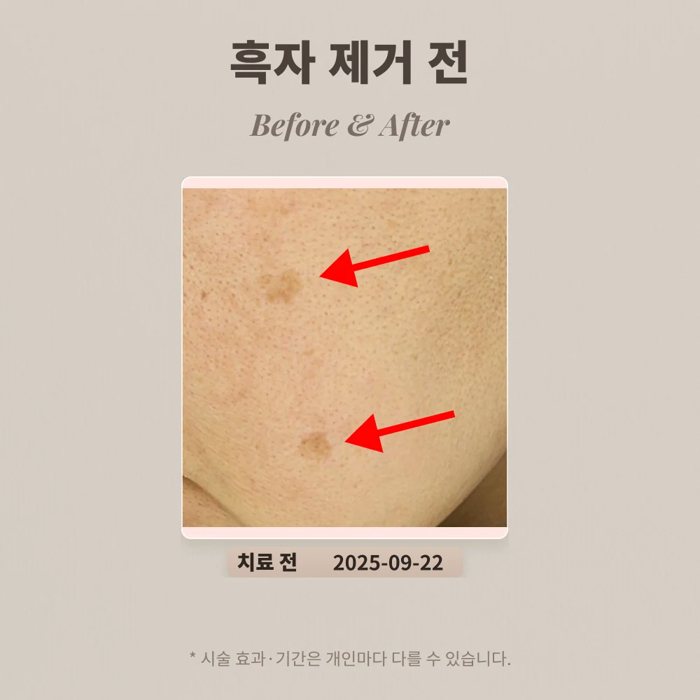 40대 여성 중안면 일광흑자 치료 사례