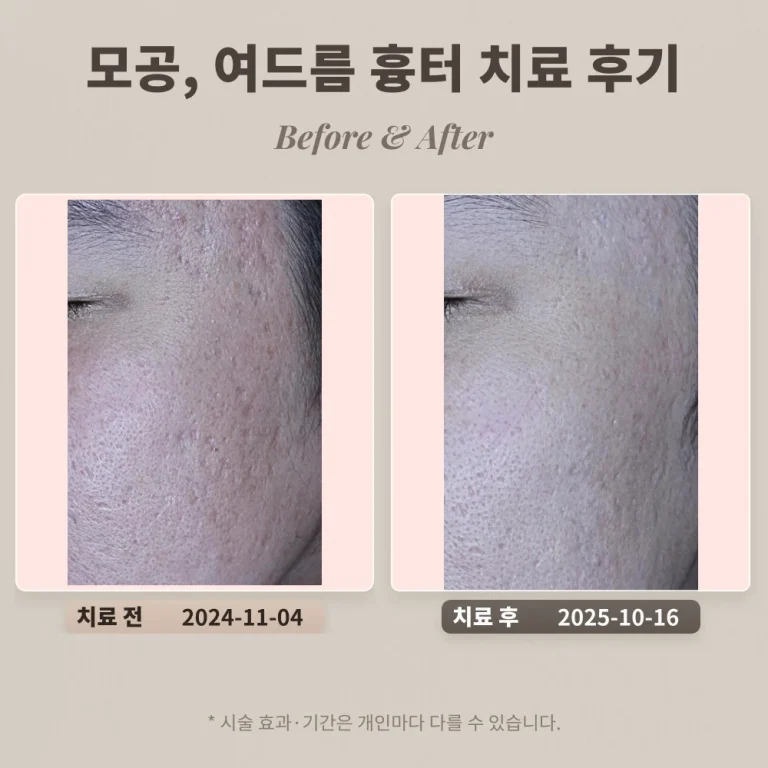 모공, 여드름 흉터 치료 후기 #도자기 피부를 위한 치료과정