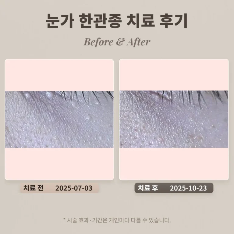 눈가 한관종 치료 후기 #비립종, 편평사마귀와 비교되는 한관종