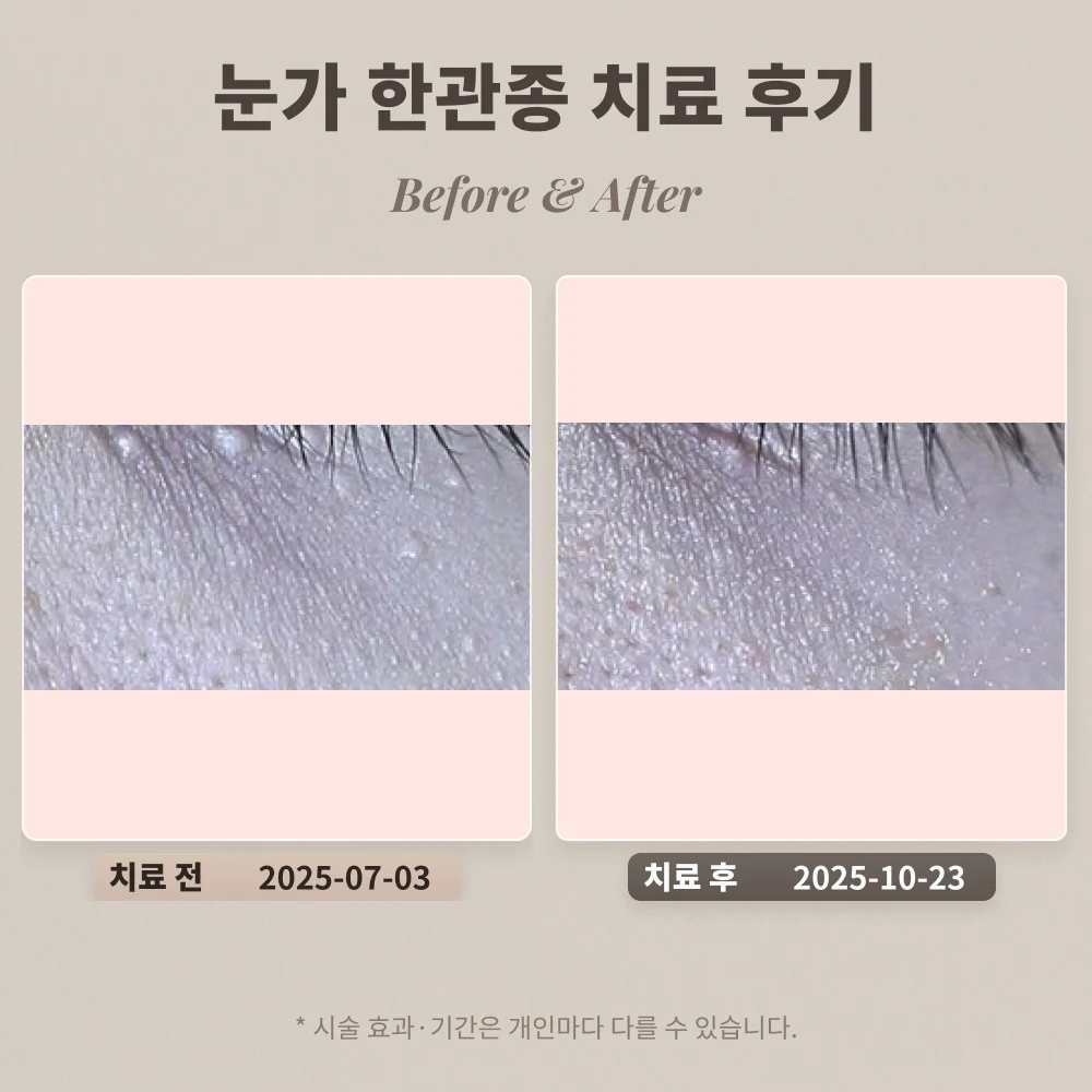 눈가 한관종 치료 후기 #비립종, 편평사마귀와 비교되는 한관종