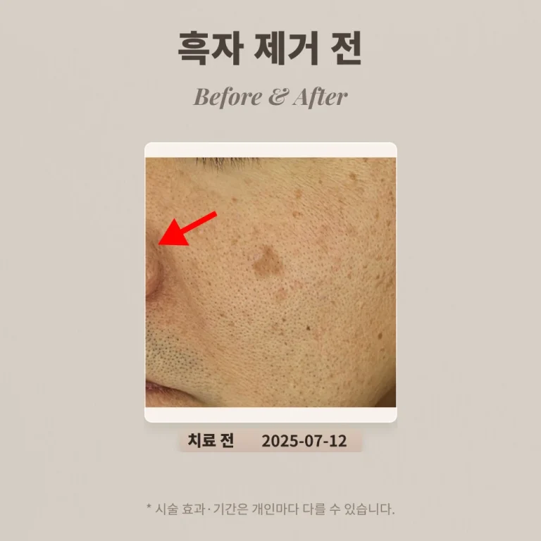 40대 남성 흑자 제거 후기