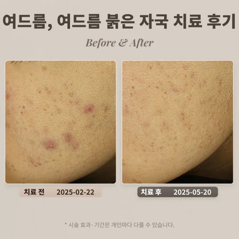 10대 여드름, 여드름 붉은 자국 치료 후기