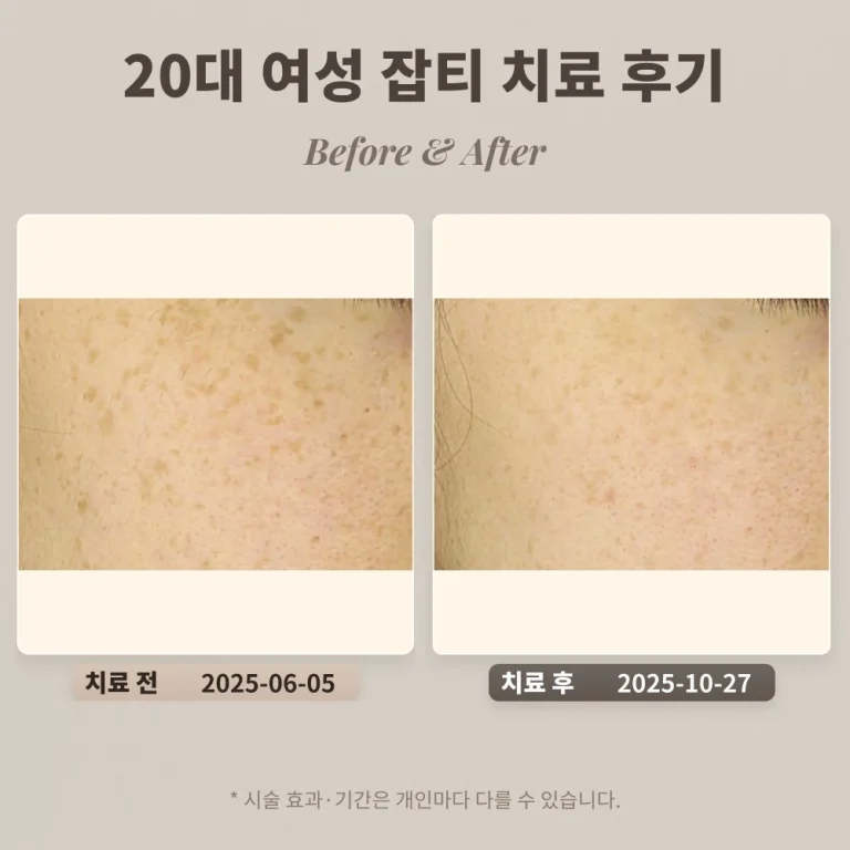 20대 여성, 잡티 치료 후기