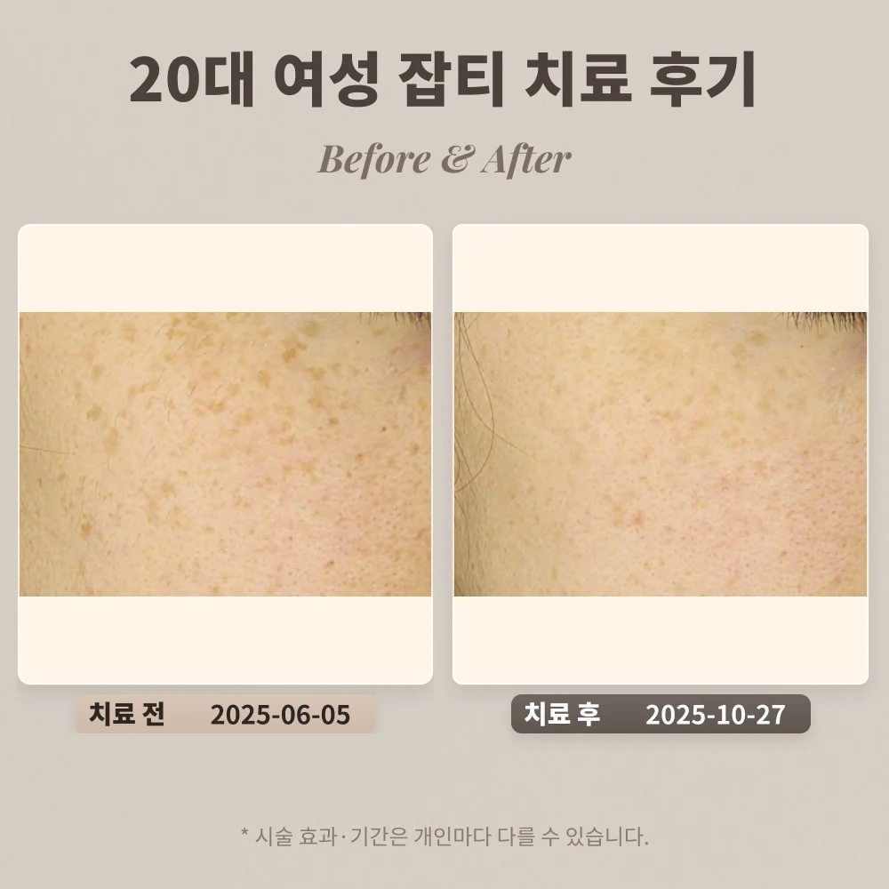 20대 여성, 잡티 치료 후기