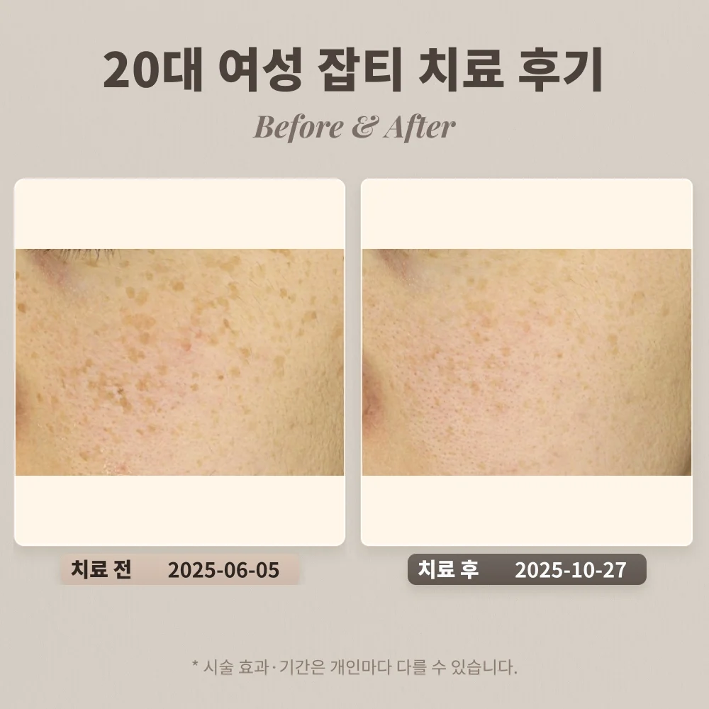 20대 여성, 잡티 치료 후기