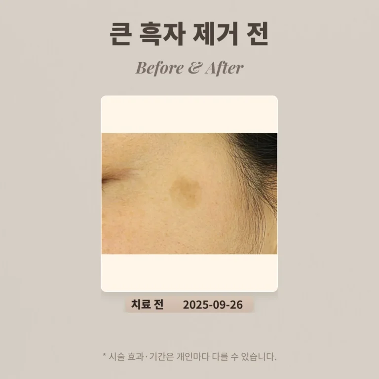 30대 여성 관자 부근 큰 흑자(갈색 반점) 제거 후기
