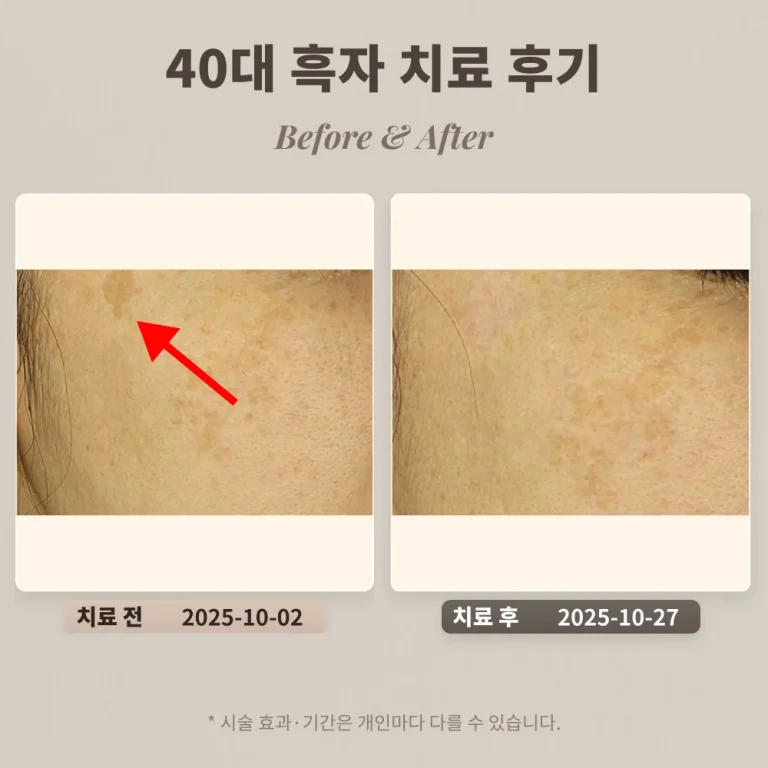 40대 여성 얼굴 곳곳에 있는 흑자 치료 후기_한티 피부과
