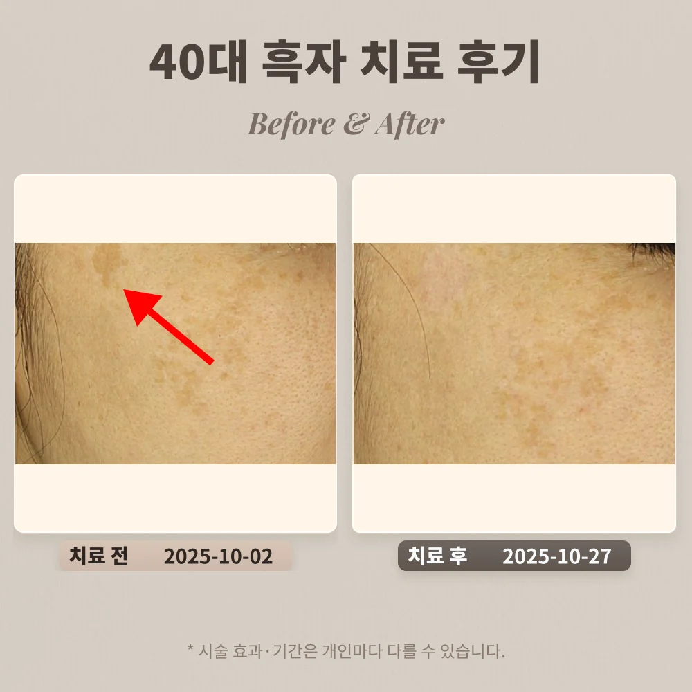 40대 여성 얼굴 곳곳에 있는 흑자 치료 후기_한티 피부과