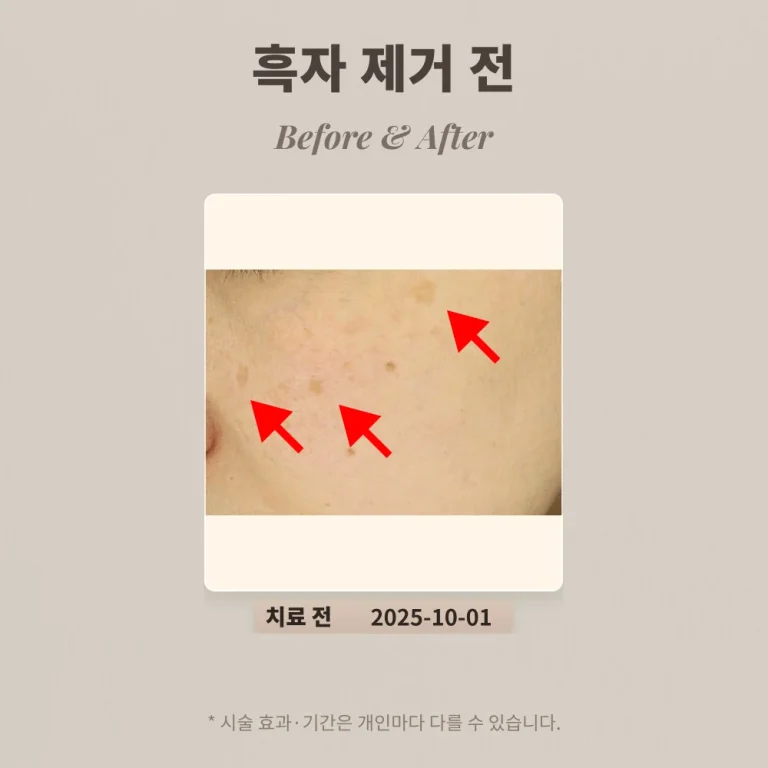 40대 여성 흑자 리팟레이저 1회 후기_한티피부과