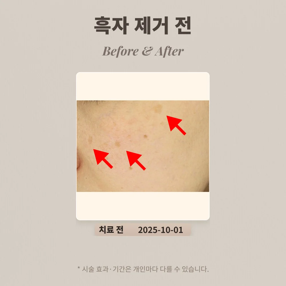 40대 여성 흑자 리팟레이저 1회 후기_한티피부과