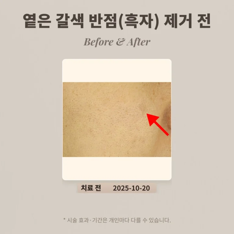 30대 옅은 갈색 반점(색소침착으로 오인) 제거 후기