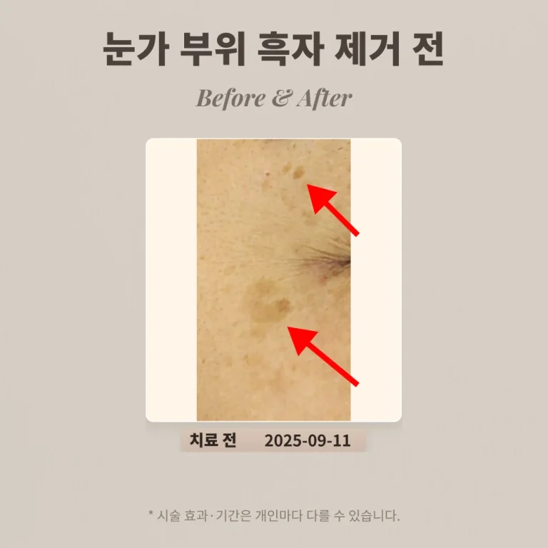 대치피부과 40대 눈가부위 흑자 제거 후기