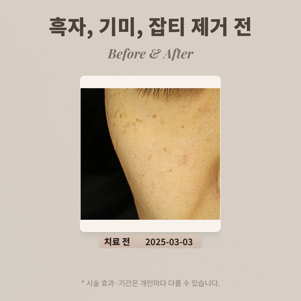 40대 여성 흑자, 기미, 잡티 제거 후기_한티역피부과 후기
