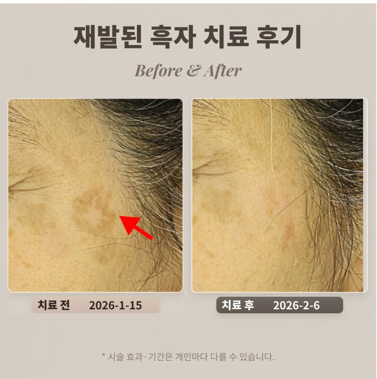 30대 남성 갈색반점, 흑자 제거 사례_리팟레이저 후기