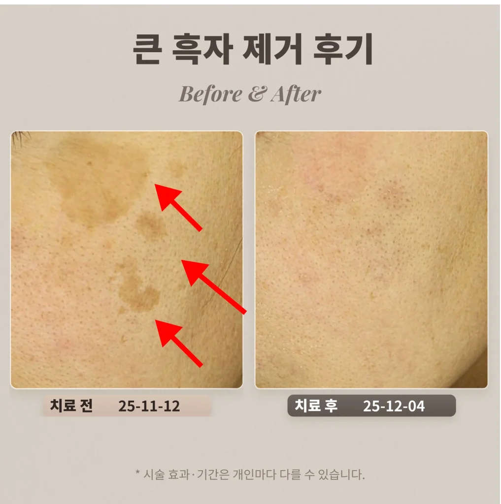 40대 눈가 큰 흑자 제거 후기_제거시 주의할 점