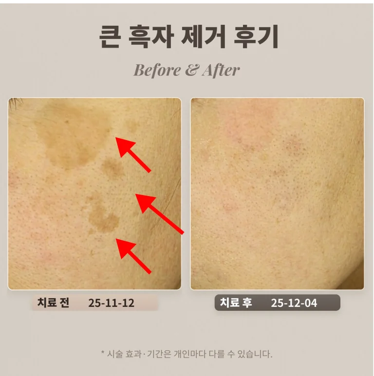 40대 눈가 큰 흑자 제거 후기_제거시 주의할 점
