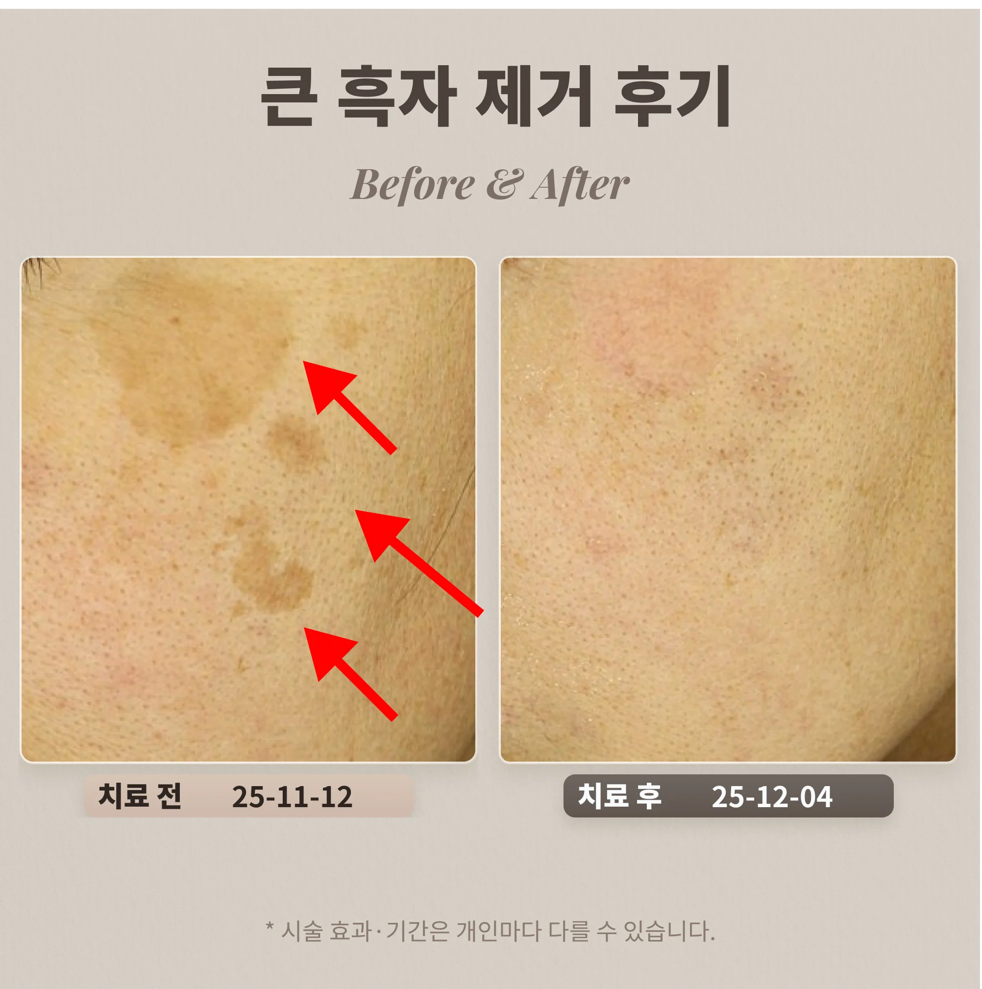 눈가의 큰 흑자를 치료하며 주의한 점을 정리한 사례
